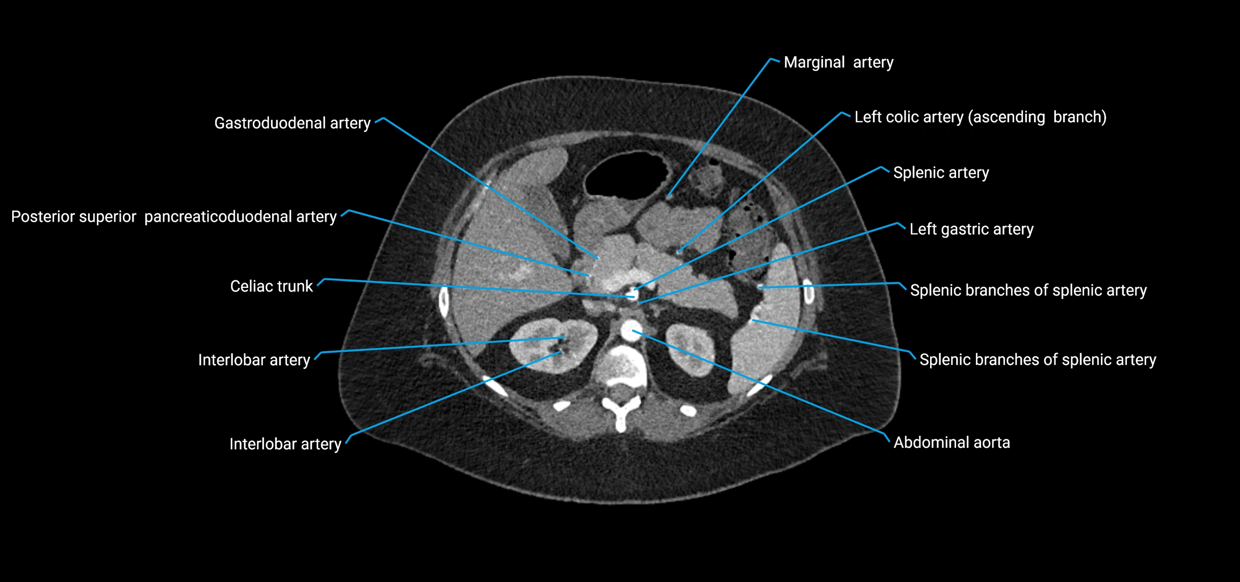 CTA abdomen axial cross sectional anatomy labelled image_55 (2).webp